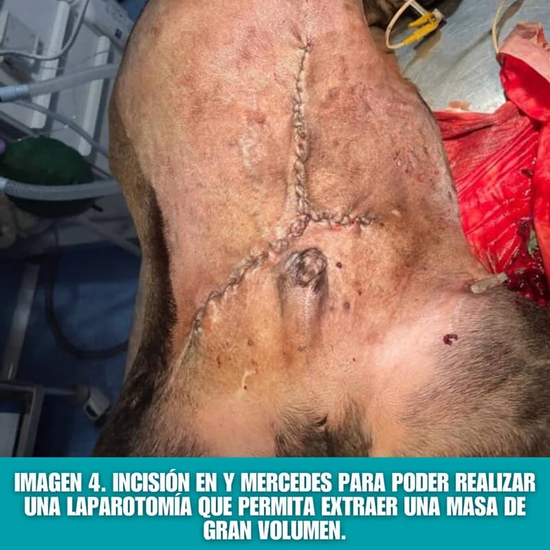 imagen 4: incisión en y mercedes para laparotomía