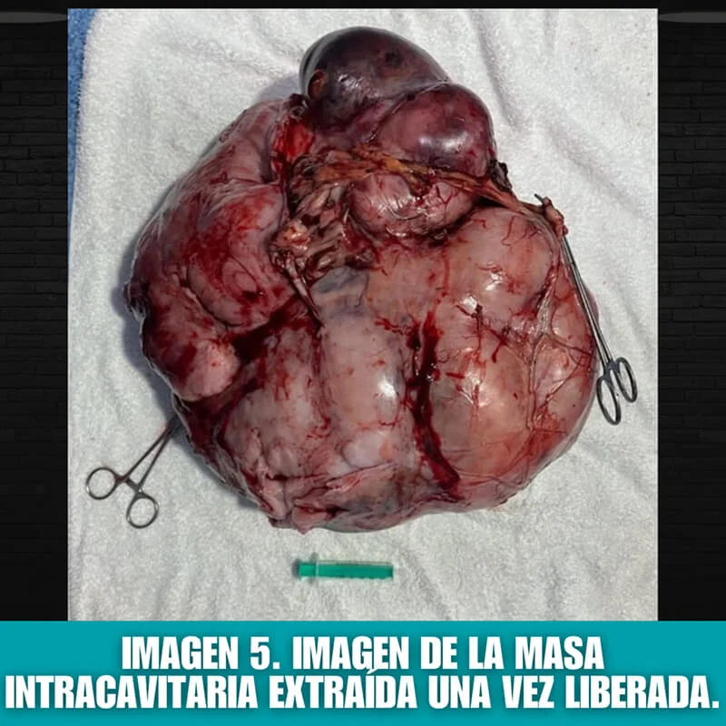 imagen 5: masa intracavitaria extraída